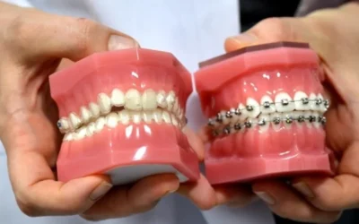 Ortodontik Tedavide Şeffaf Plak vs Diş Teli